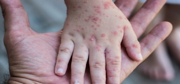 Los niños del estado de Tamaulipas enfrentan pandemia coxsackie en silencio: “les salen como ámpulas, manchitas rojas en las manos y garganta”
